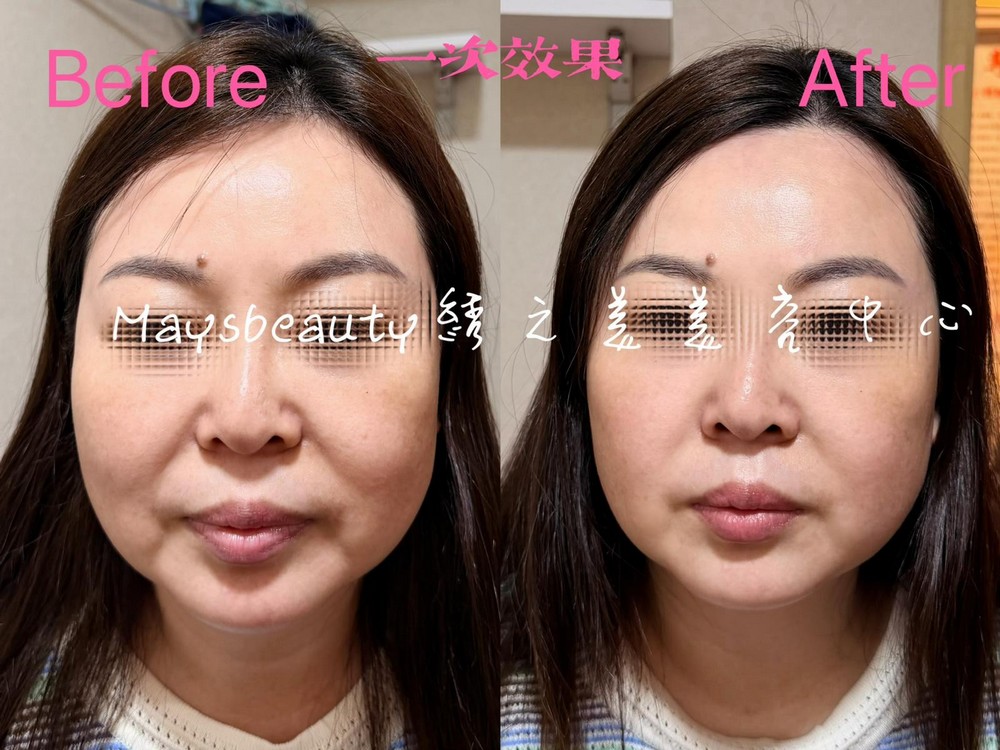 https://maysbeautyhk.com/files/%E9%88%A6%20Hifu.jpeg